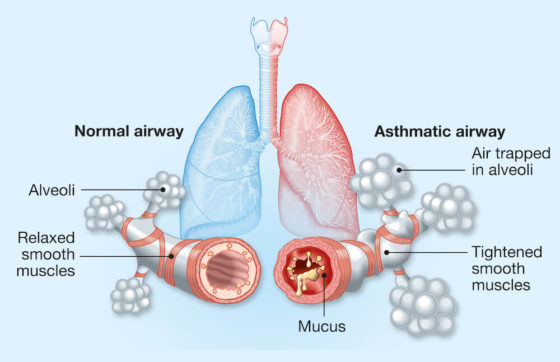 Should I See an Allergist or a Pulmonologist for My Asthma | Advanced ...